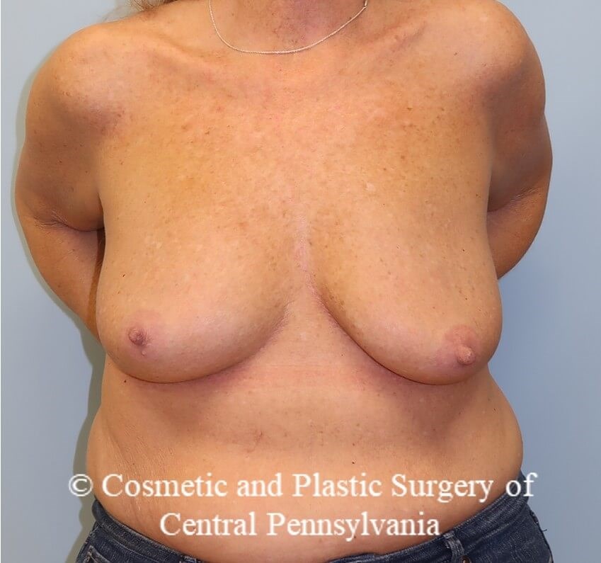 Breast Augmentation Before