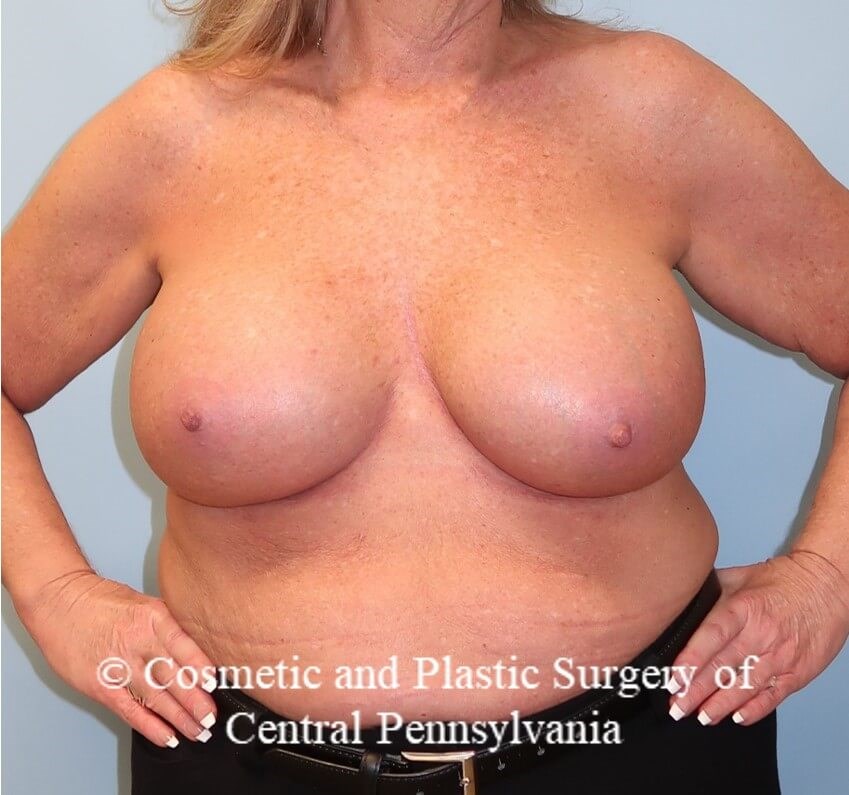 Breast Augmentation After