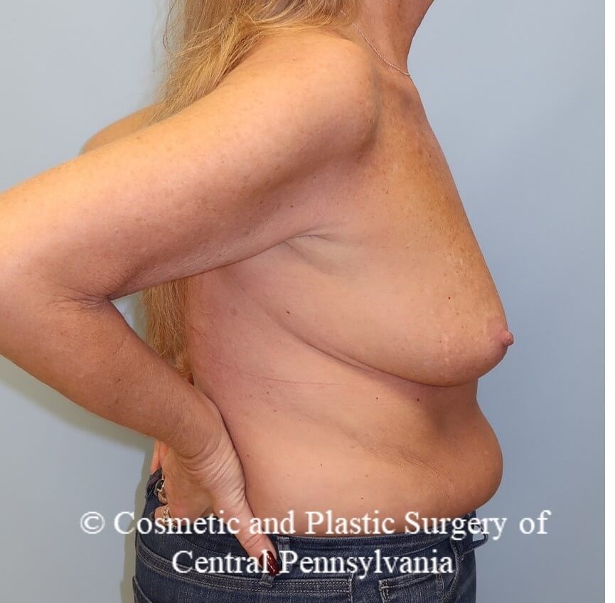 Breast Augmentation Before