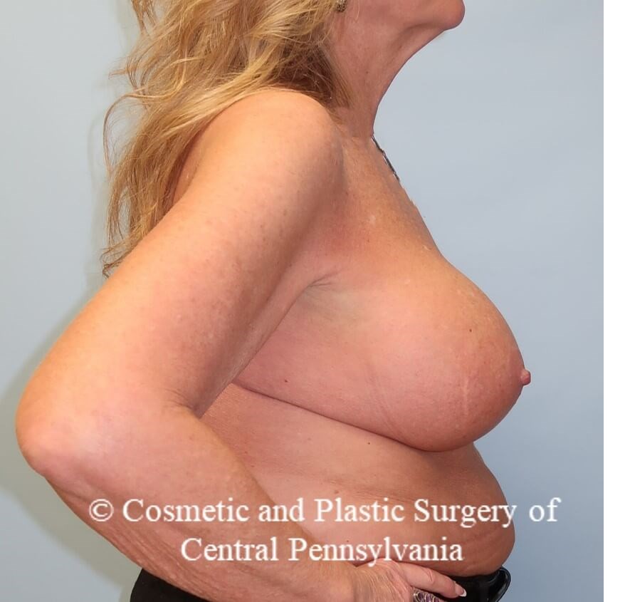 Breast Augmentation After