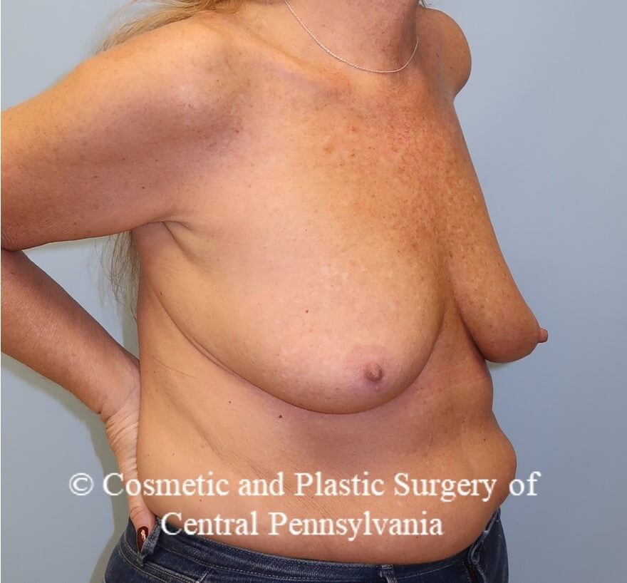 Breast Augmentation Before