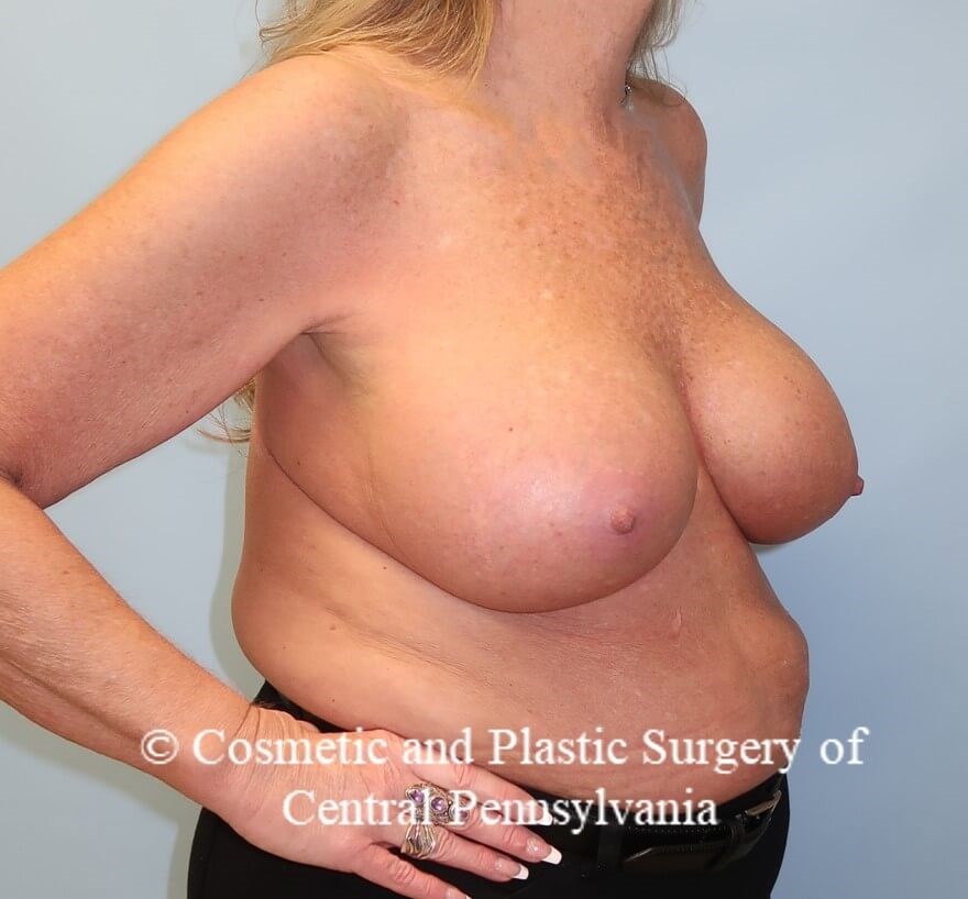 Breast Augmentation After