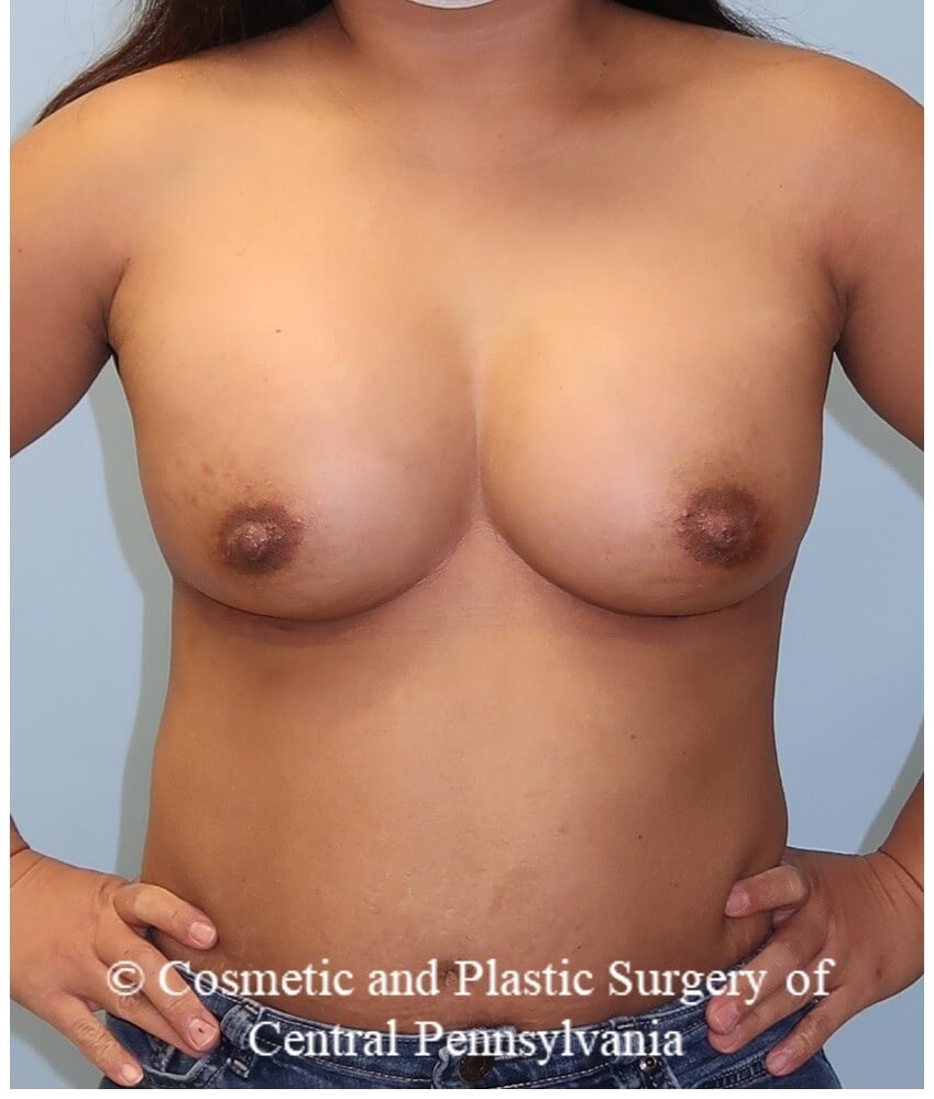 Breast Augmentation After