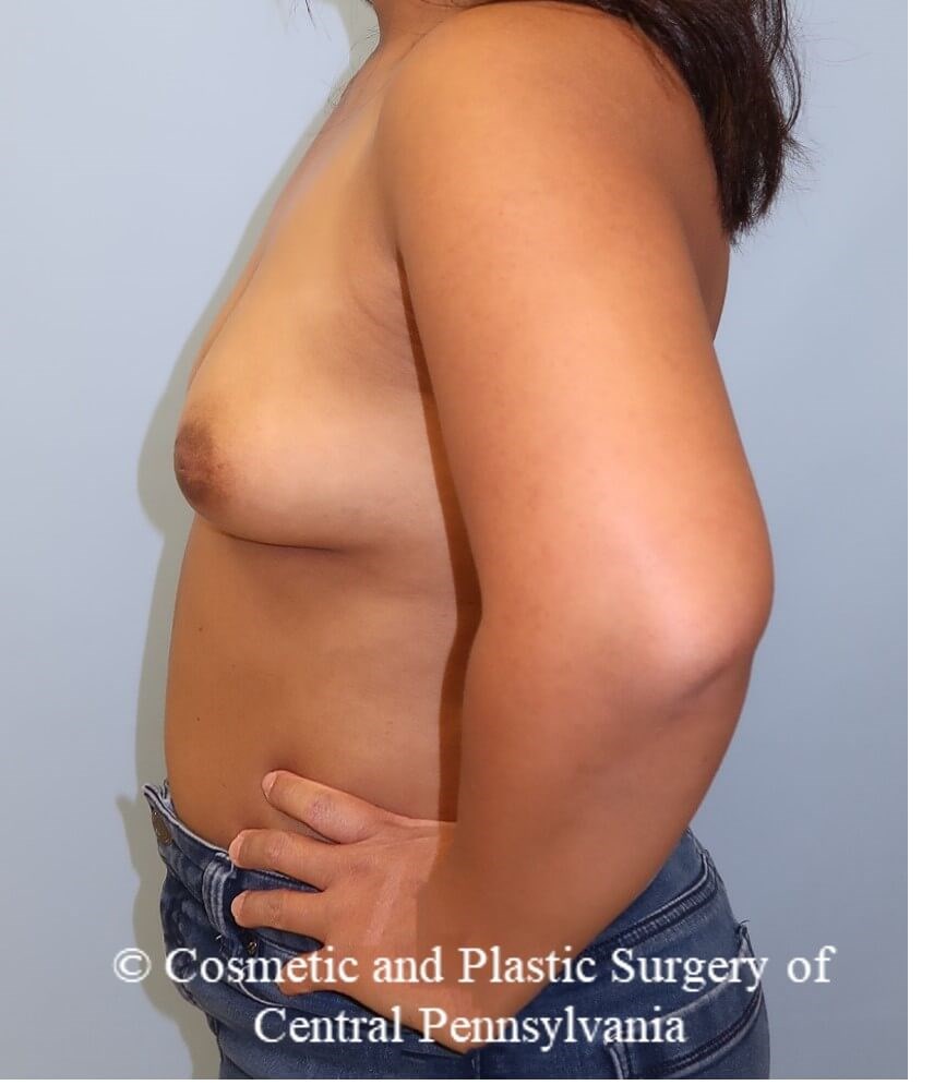 Breast Augmentation Before