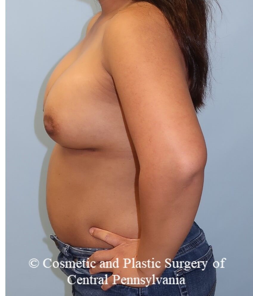 Breast Augmentation After
