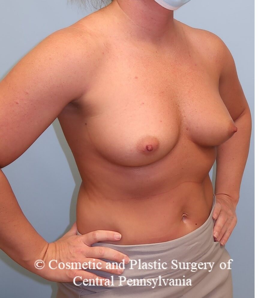 Breast Augmentation Before