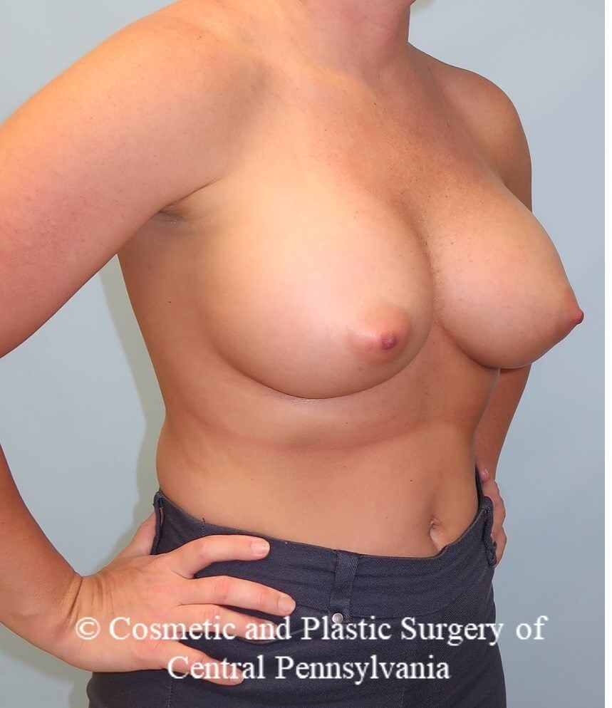 Breast Augmentation After