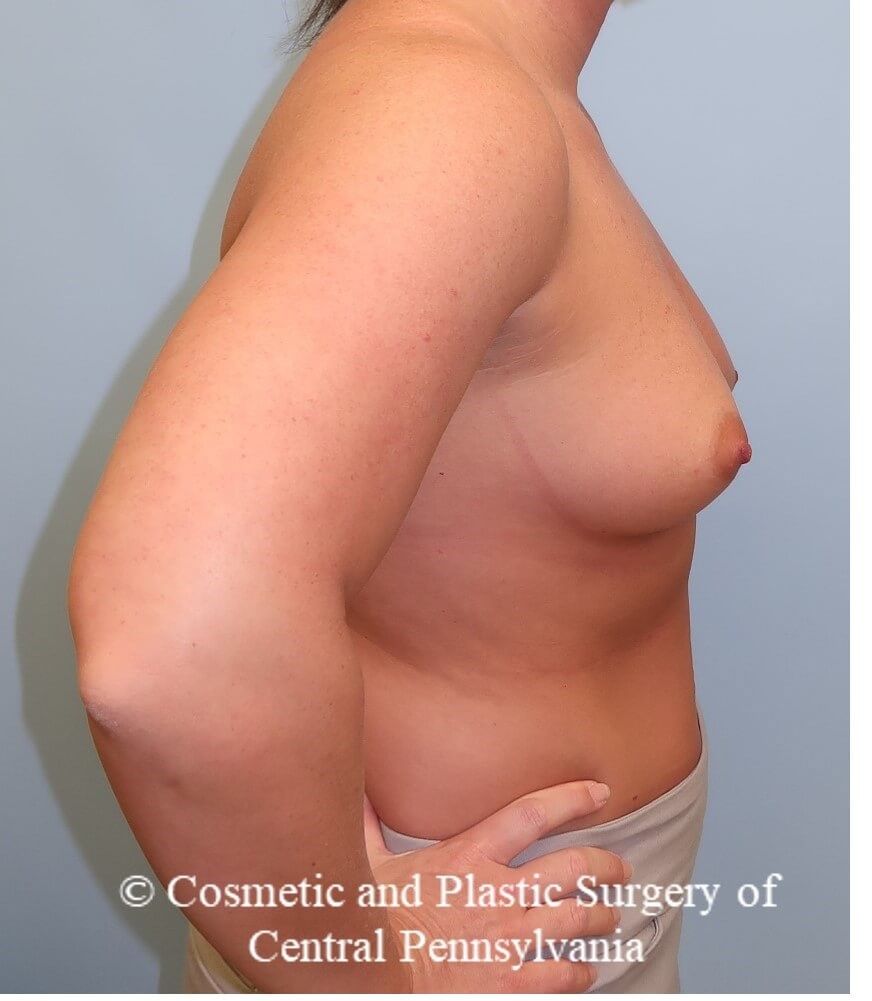Breast Augmentation Before