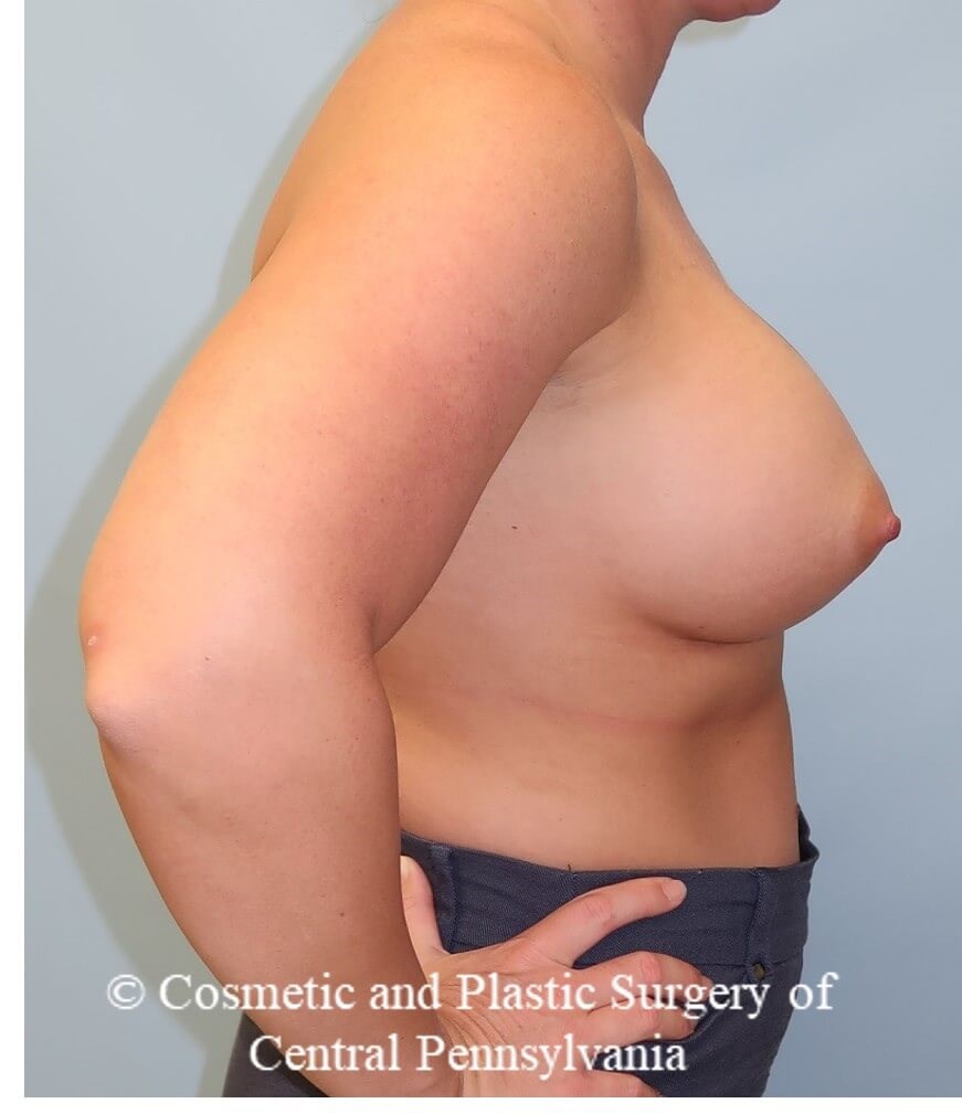 Breast Augmentation After