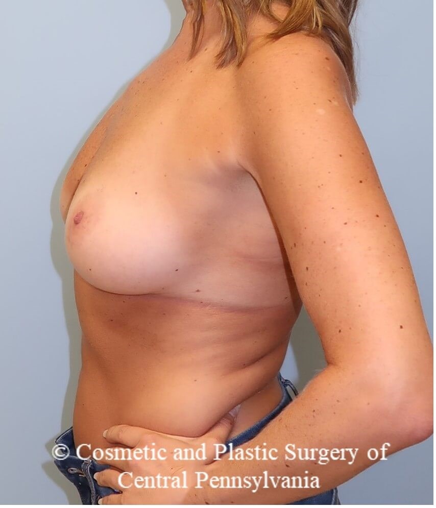 Breast Augmentation Before