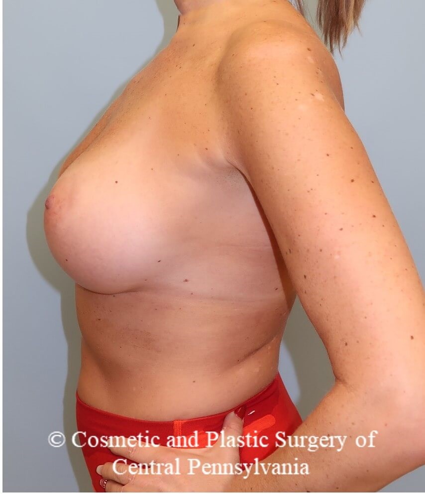 Breast Augmentation After