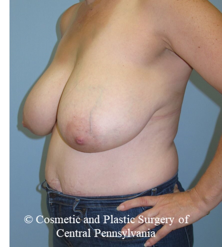 Breast Reduction Before