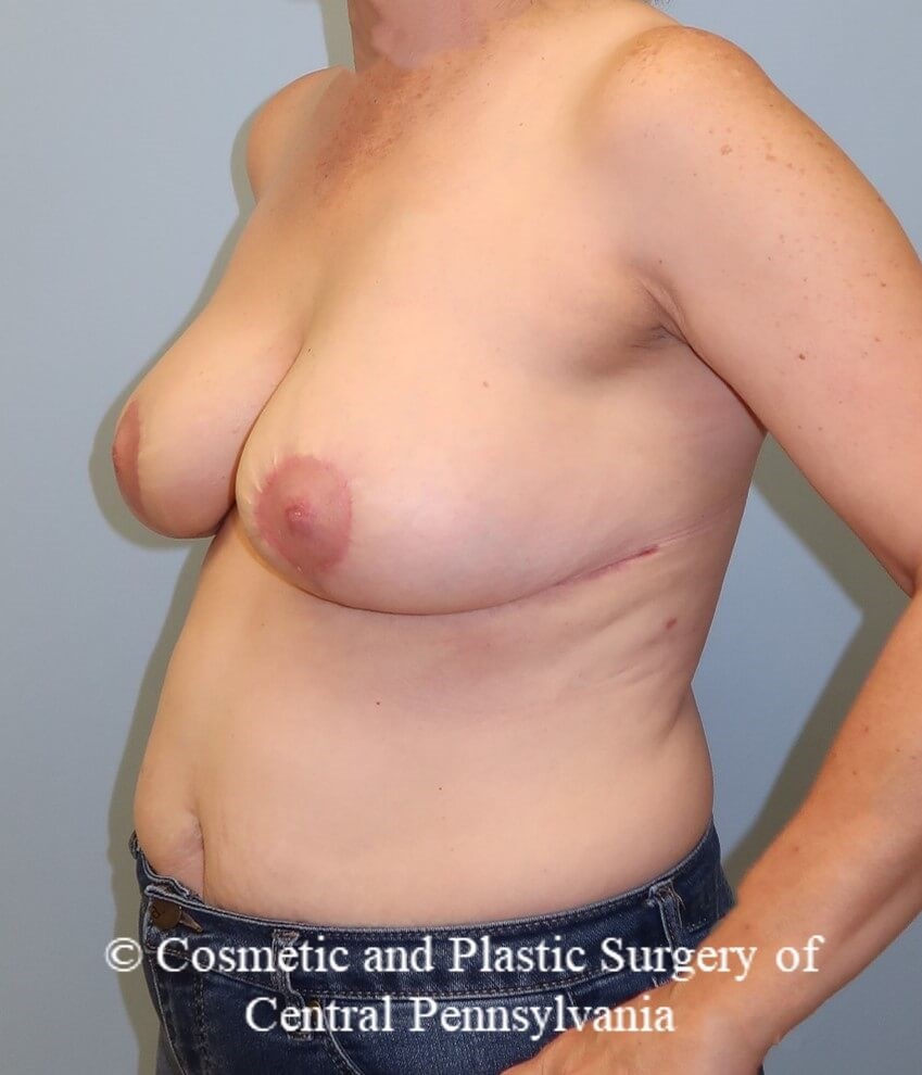 Breast Reduction After
