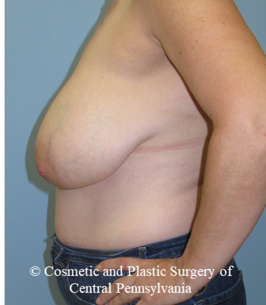 Breast Reduction Before