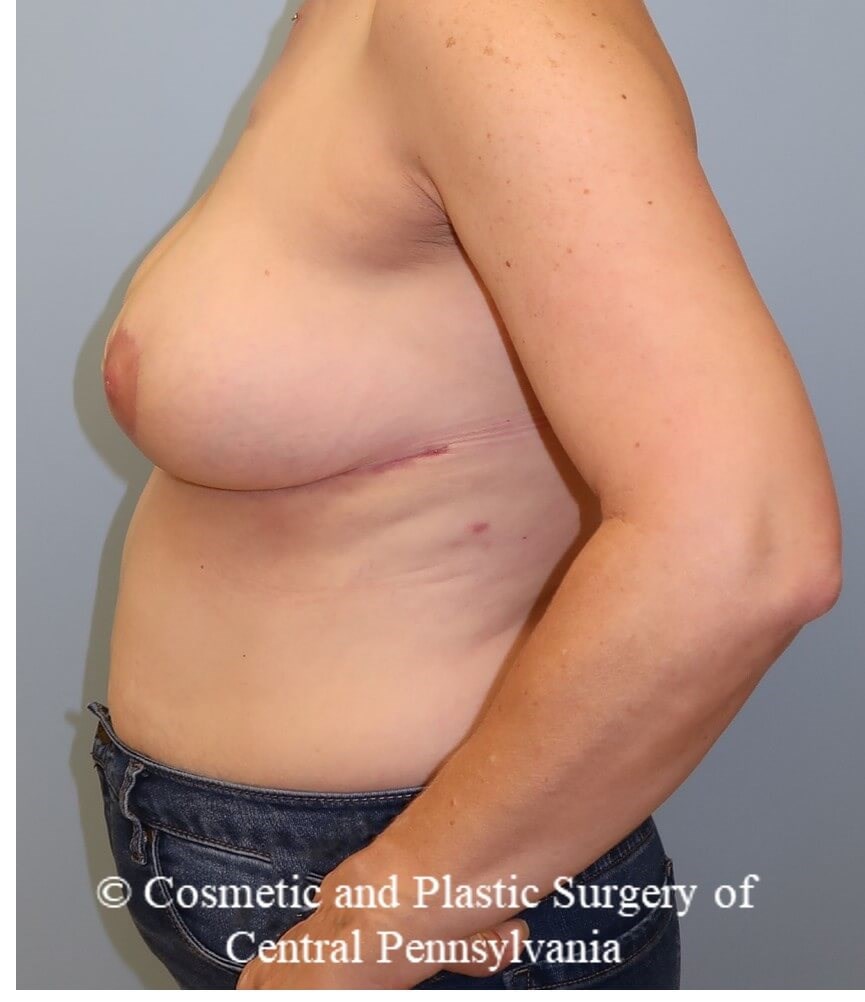 Breast Reduction After