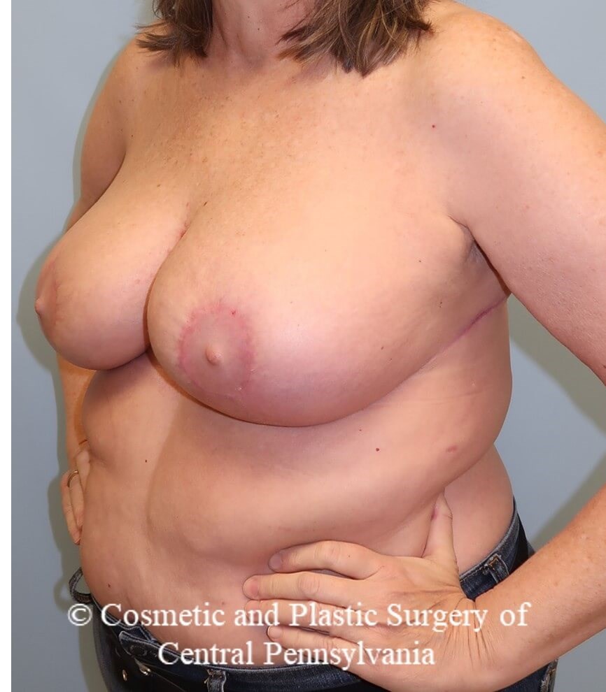 Breast Reduction After