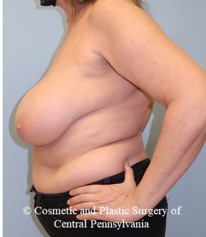 Breast Reduction Before