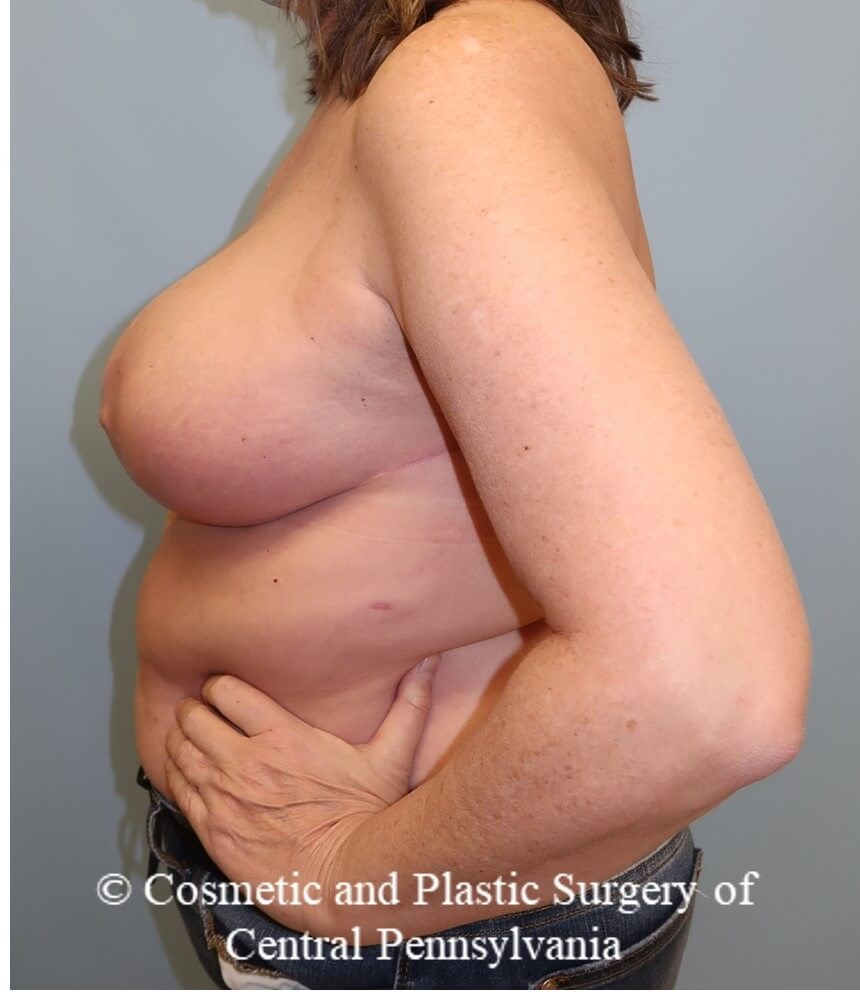 Breast Reduction After