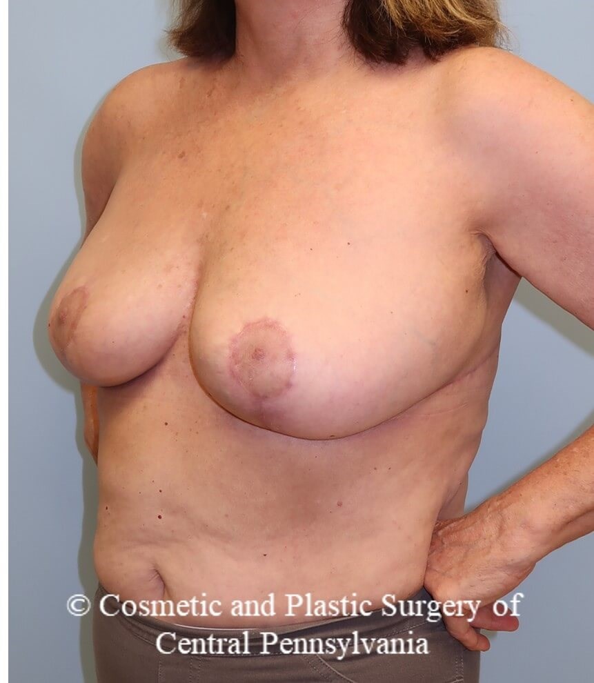 Breast Reduction After