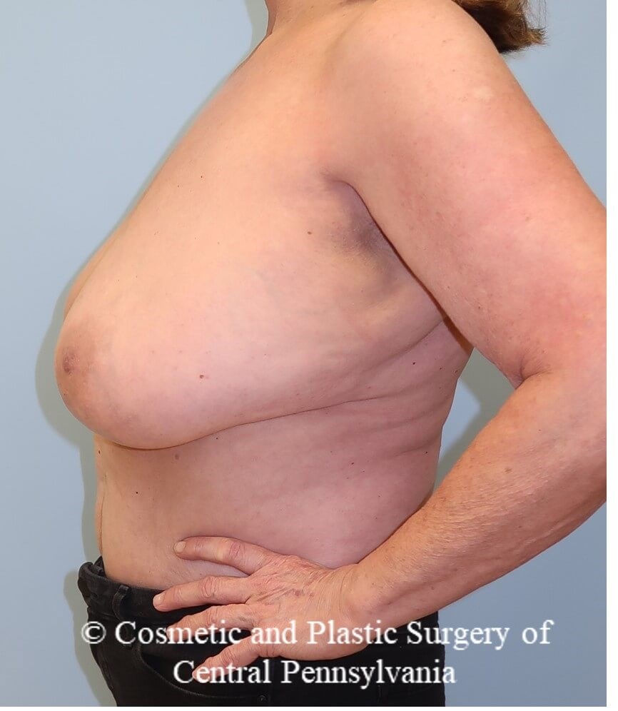 Breast Reduction Before