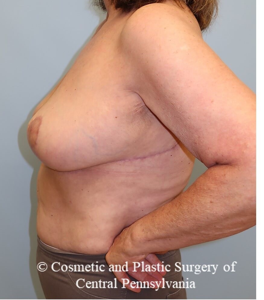 Breast Reduction After