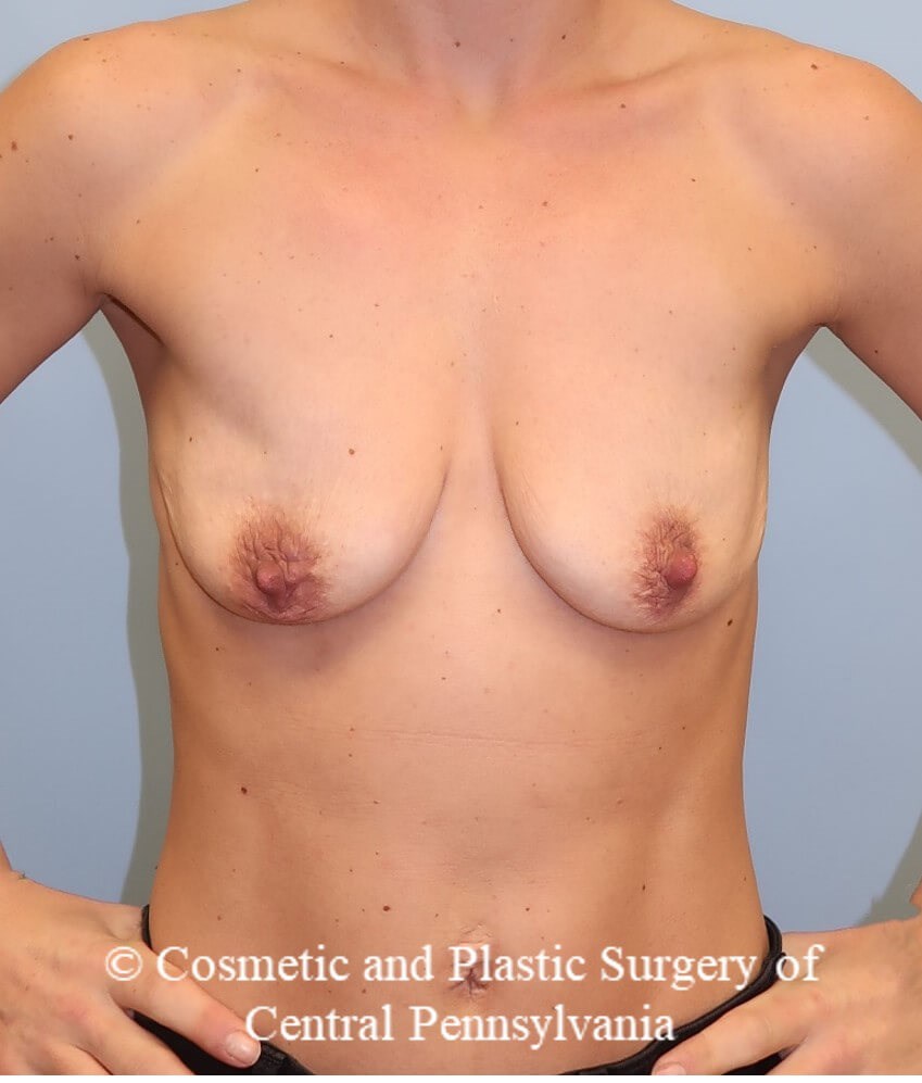 Breast Augmentation Before