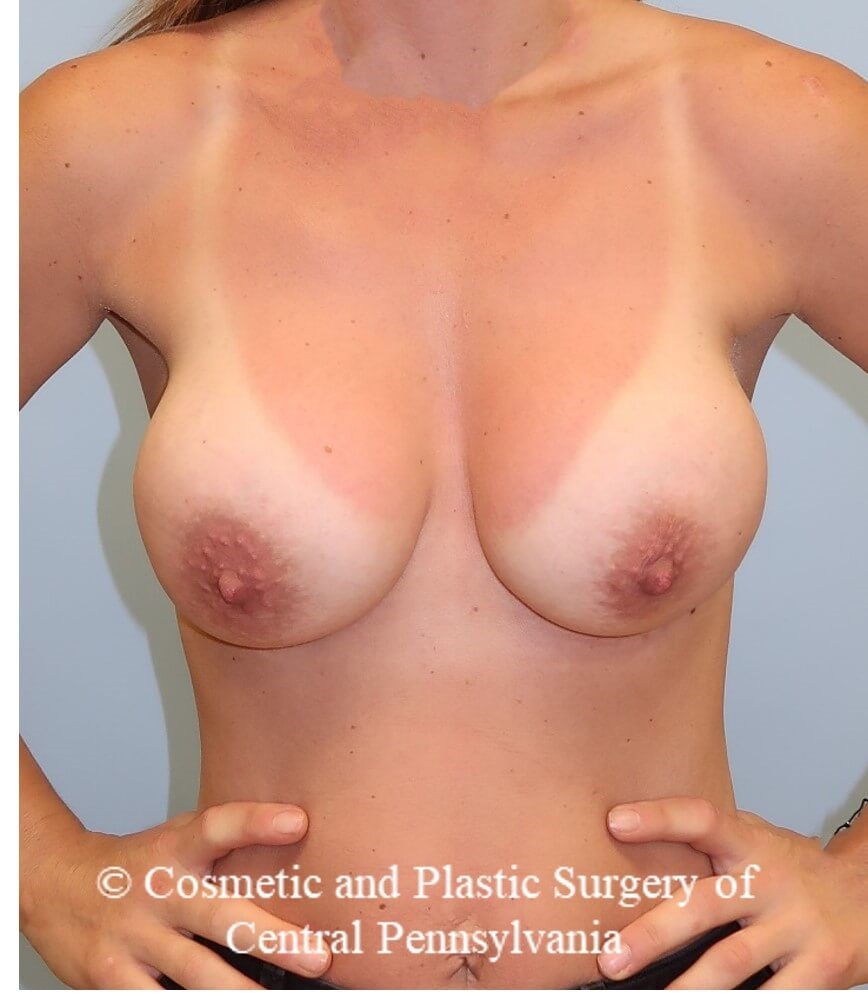 Breast Augmentation After