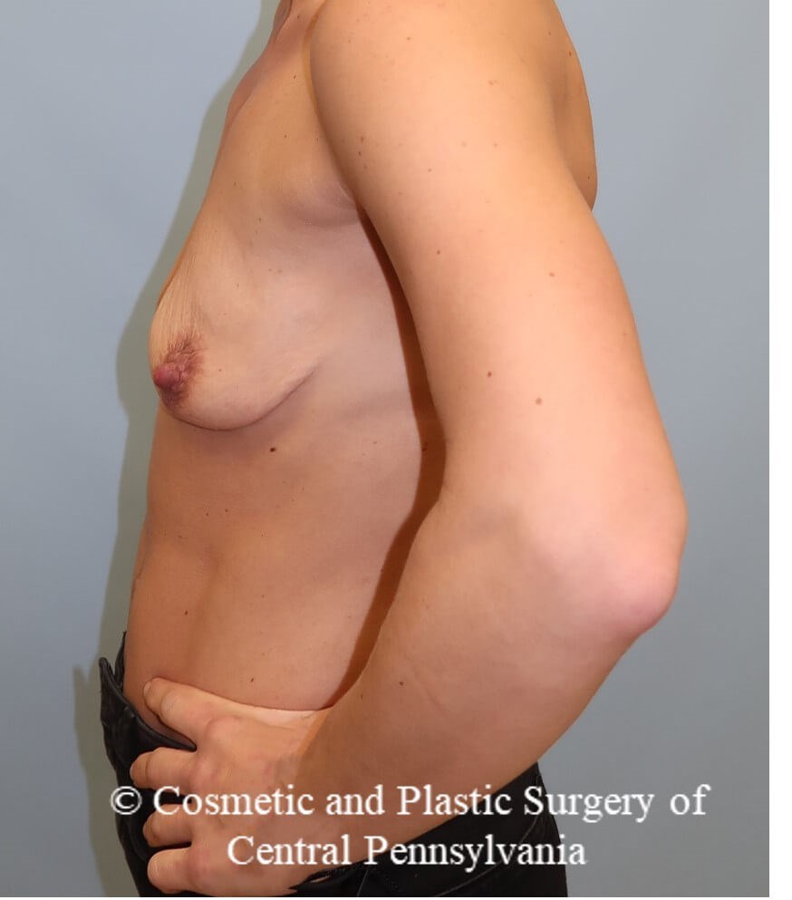 Breast Augmentation Before