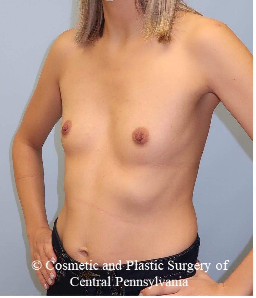 Breast Augmentation Before