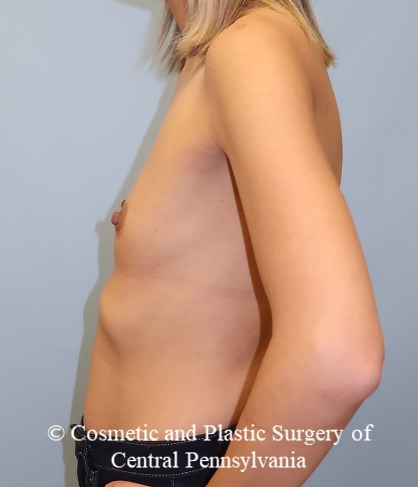 Breast Augmentation Before