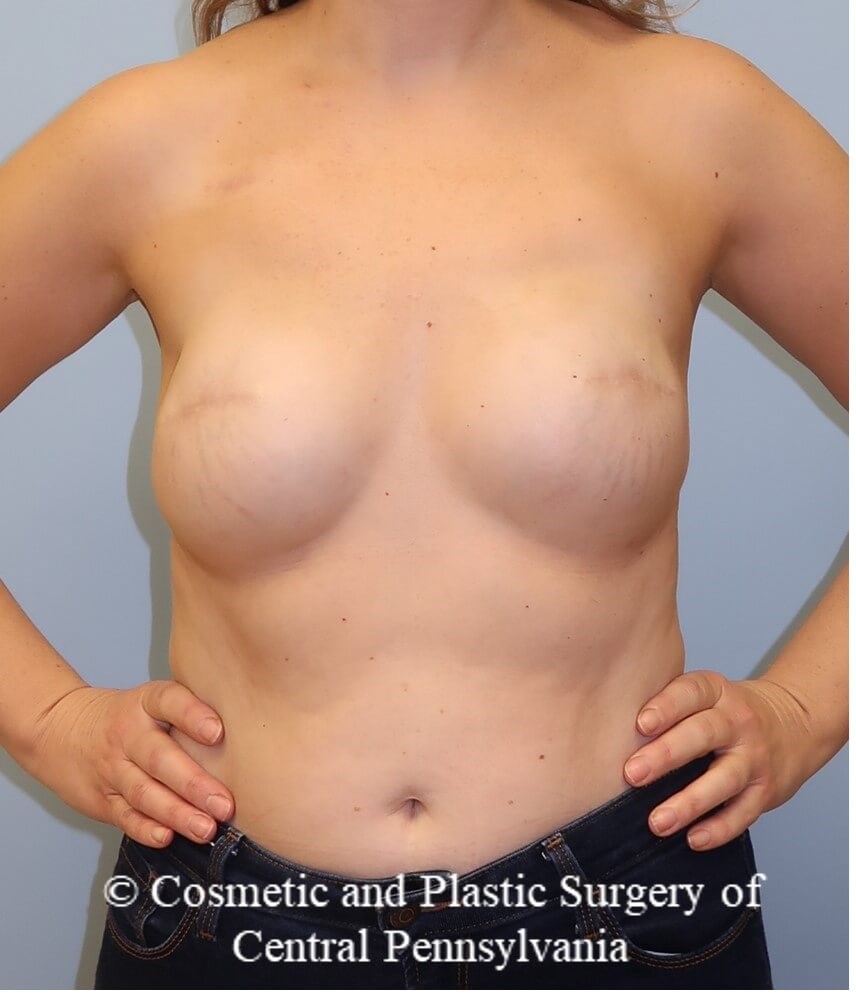 Breast Reconstruction revison Before