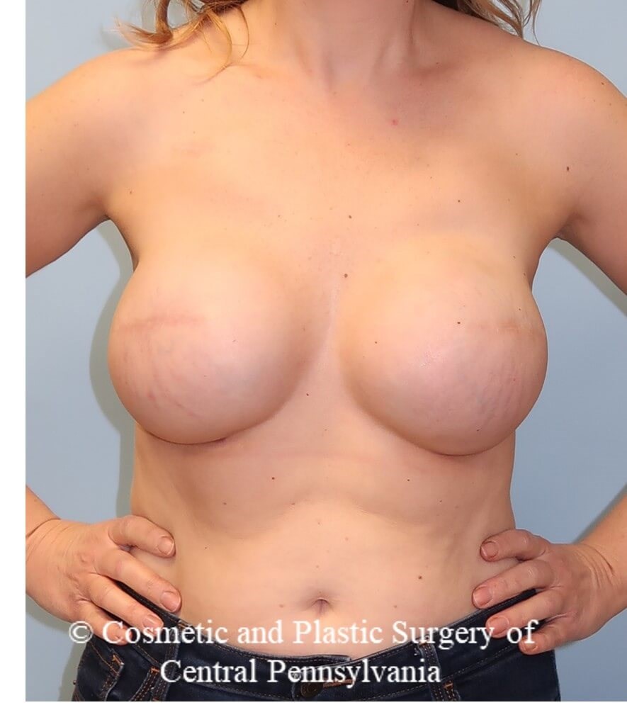 Breast Reconstruction revison After