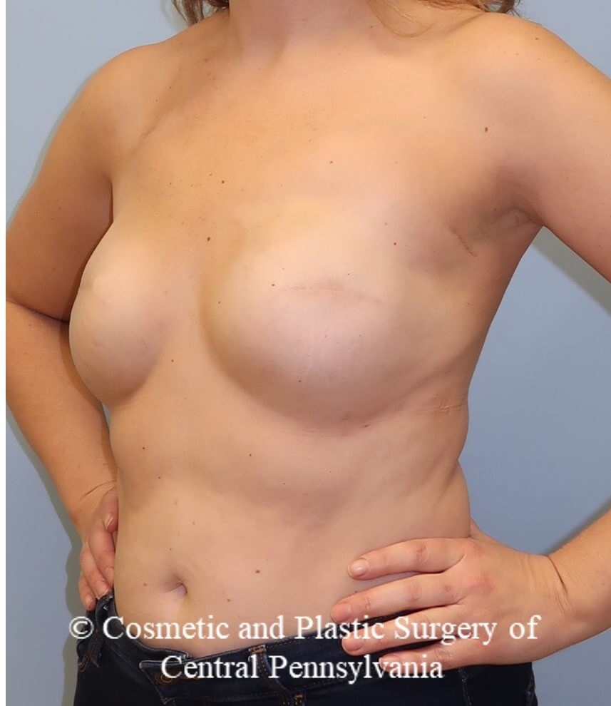 Breast Reconstruction revison Before