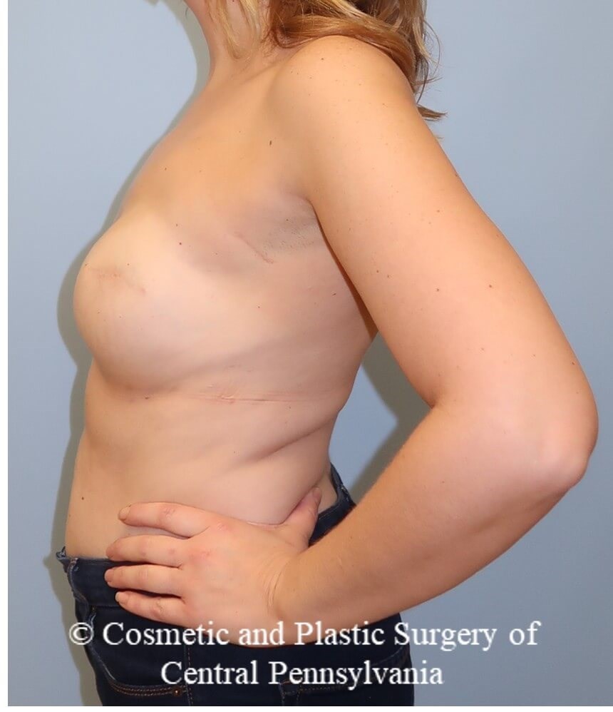 Breast Reconstruction revison Before