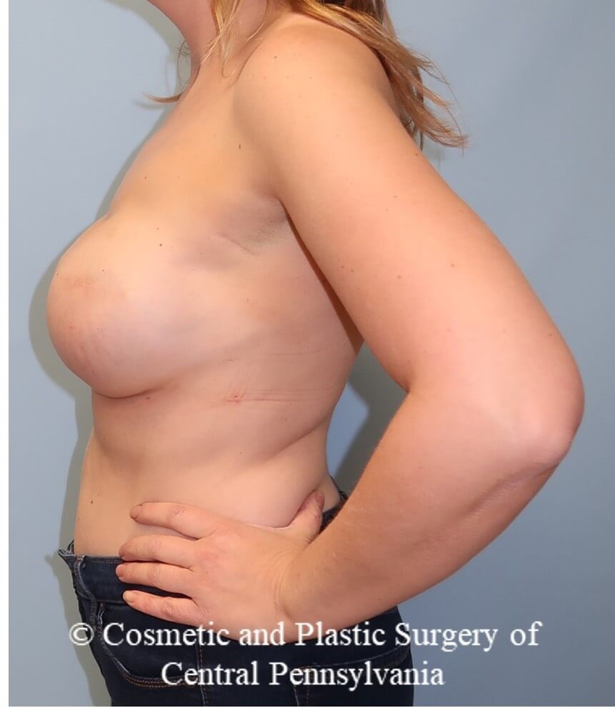 Breast Reconstruction revison After