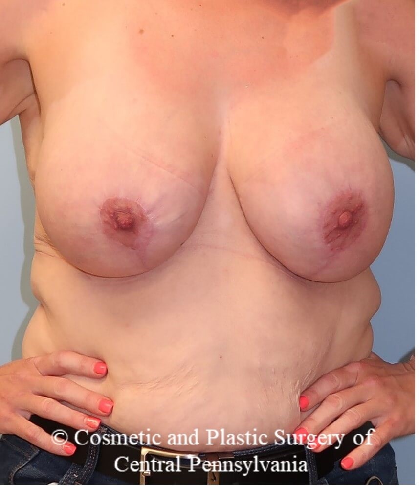 Breast Augmentation/Lift After