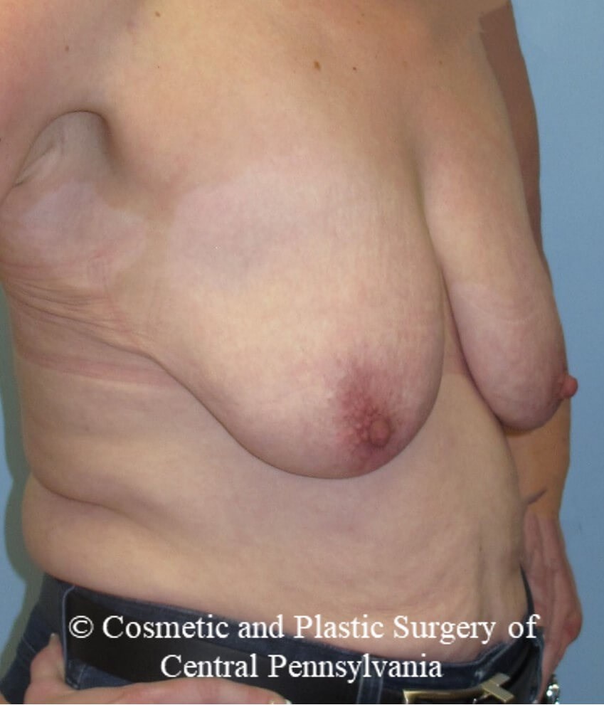 Breast Augmentation/Lift Before