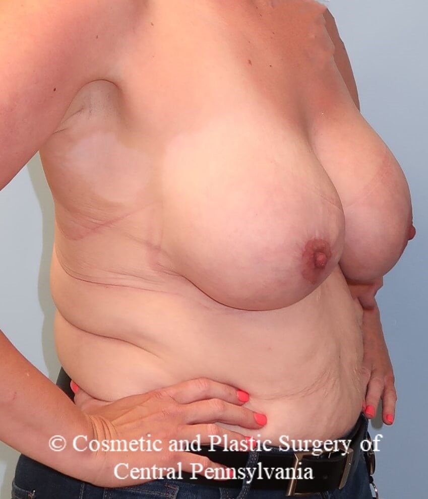 Breast Augmentation/Lift After