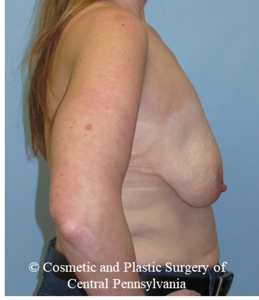 Breast Augmentation/Lift Before