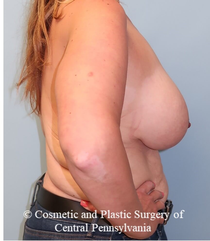 Breast Augmentation/Lift After