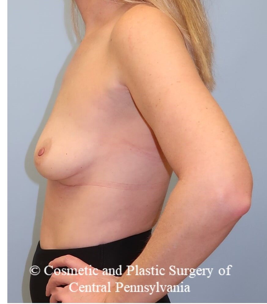 Breast Augmentation Before