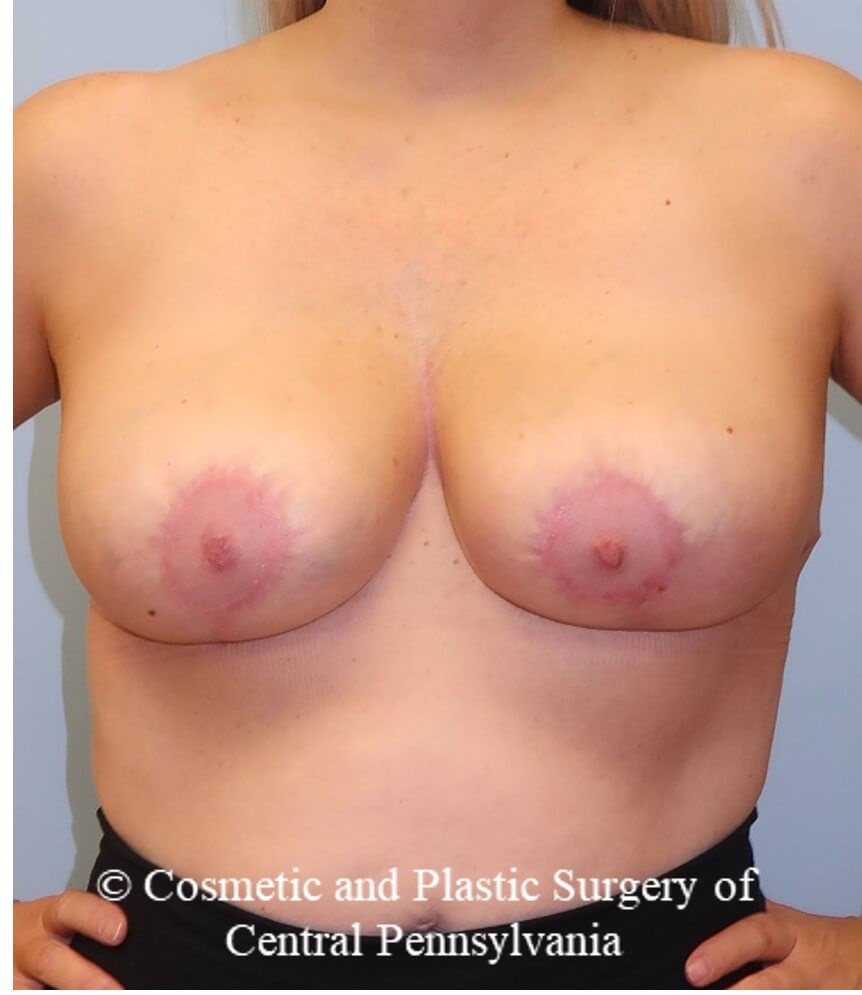 Breast Reduction After