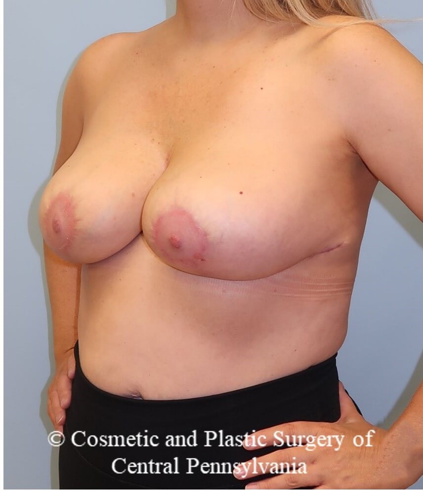 Breast Reduction After
