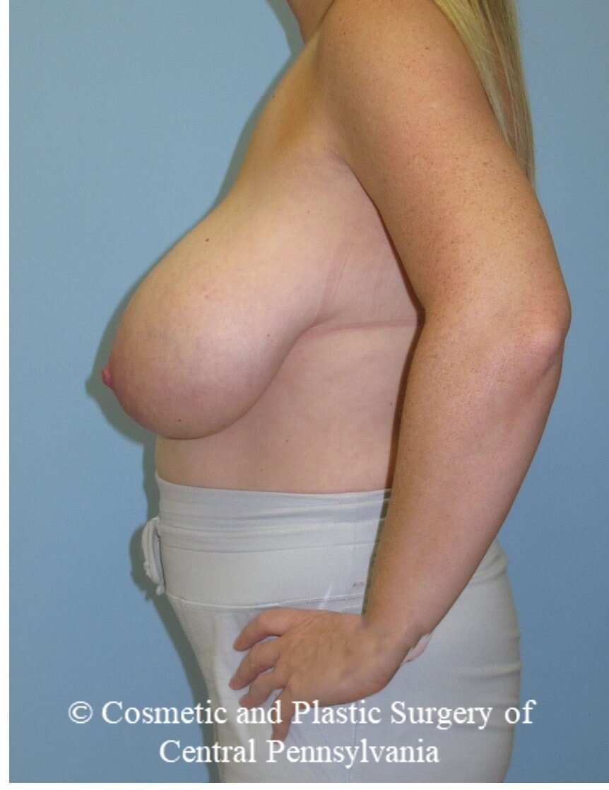 Breast Reduction Before