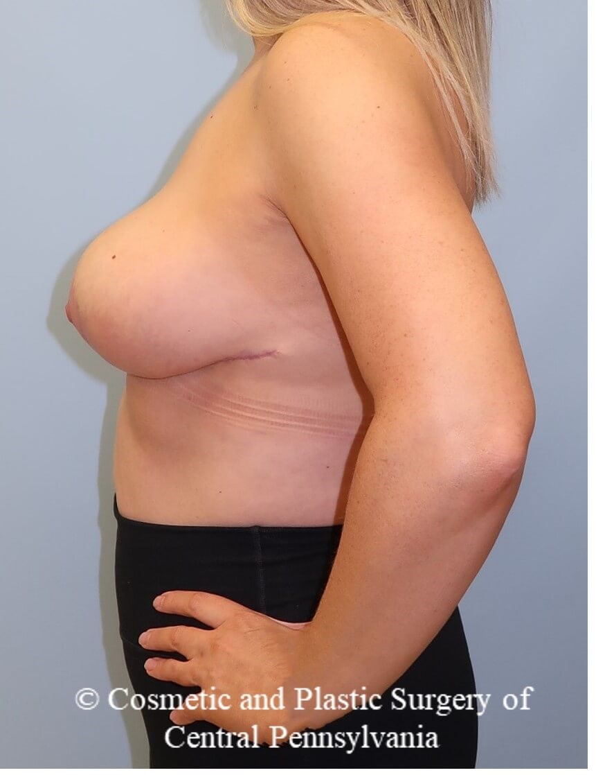 Breast Reduction After