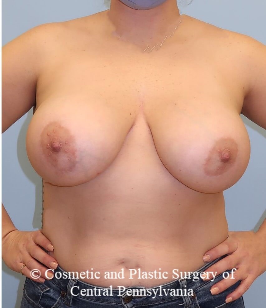 Breast Augmentation After