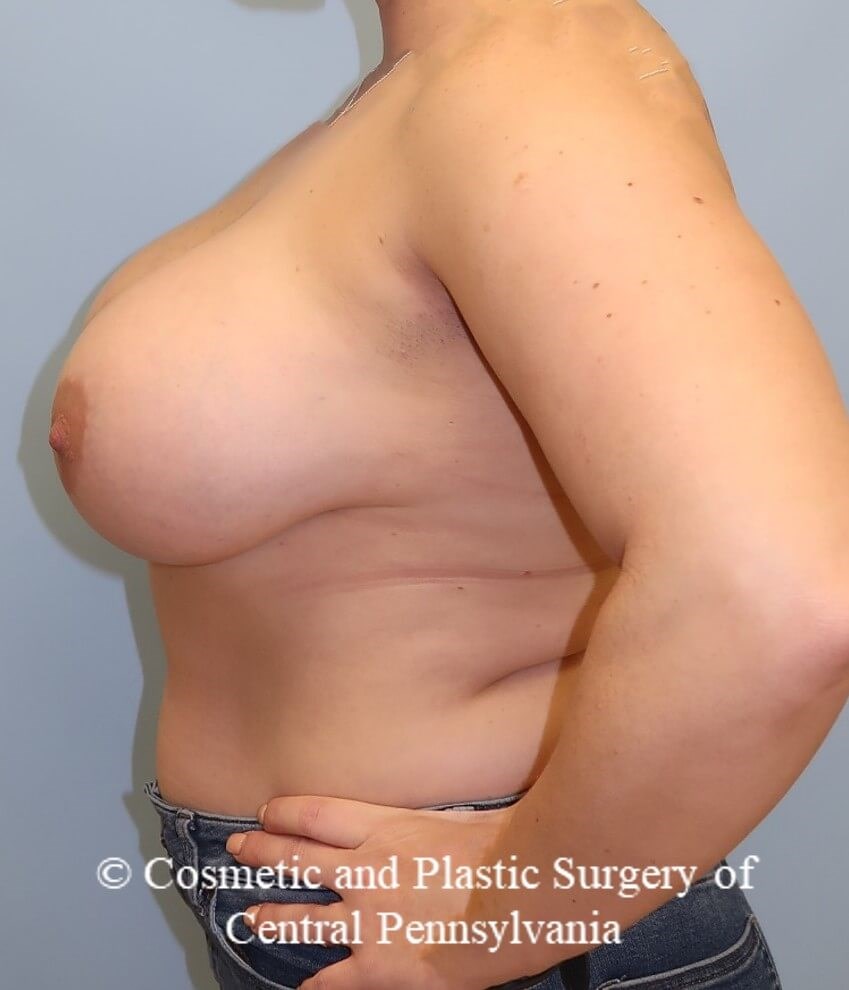 Breast Augmentation After