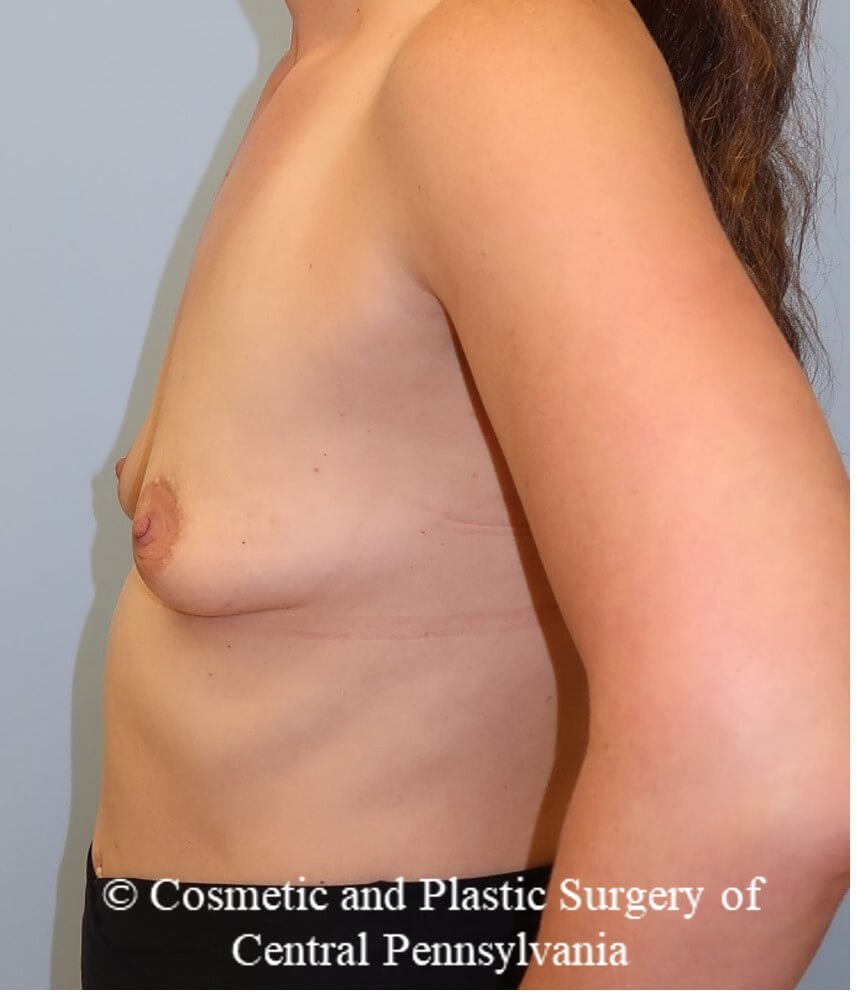 Breast Augmentation Before