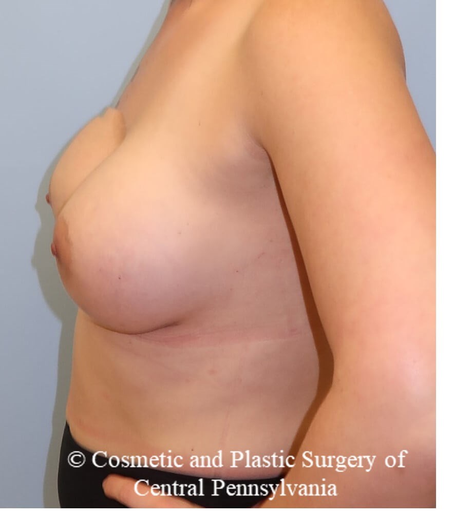 Breast Augmentation After
