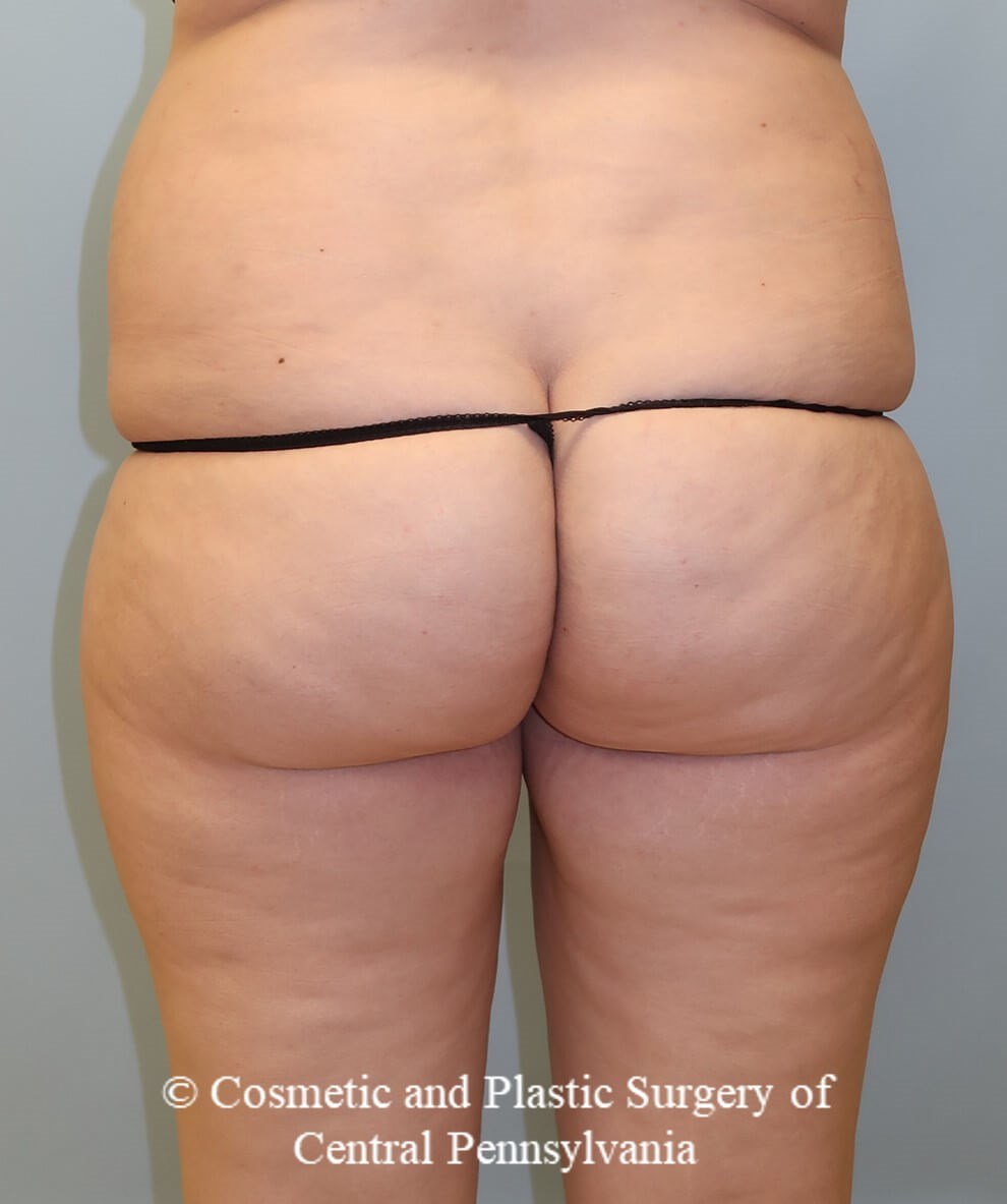 Brazilian Butt Lift Before